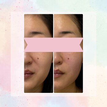 顔ジム初めてのお客様　Before:After