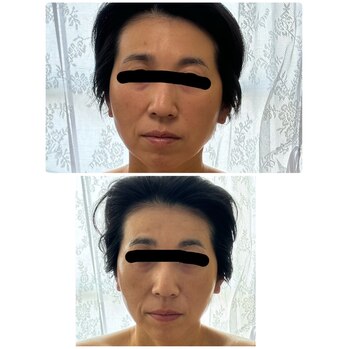 たるみ解消！！　１回で驚きの変化！