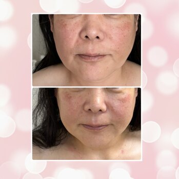 顔ジム初めてのお客様　Before:After　２